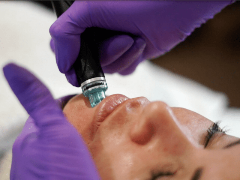 Facial Rejuvenation Treatment Sydney